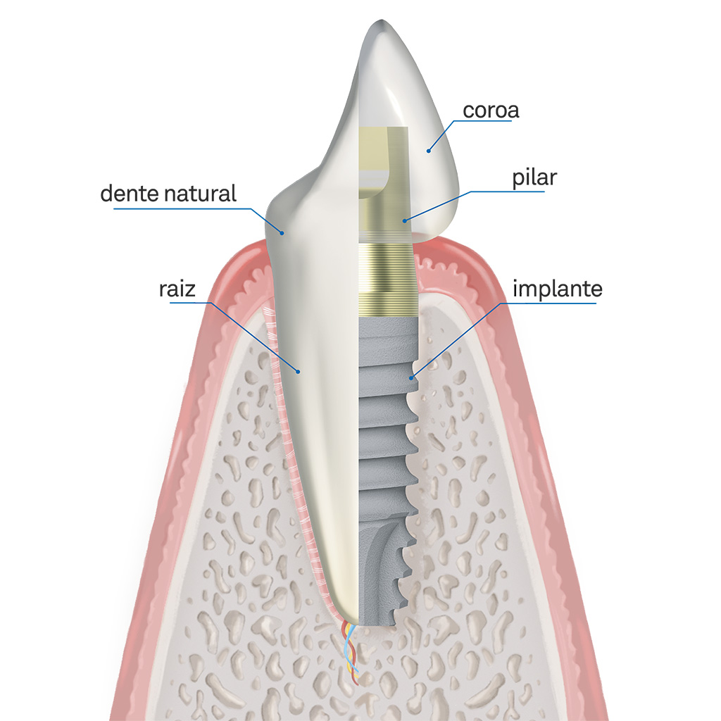 implantologia oral